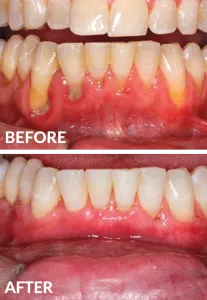 Gum recession treatment before and after comparison showing gum tissue restoration