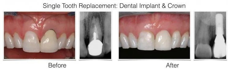 Single Implant Case 3.jpeg.001 e1642015651753 - Periodontist Philadelphia | Laudenbach Periodontics & Dental Implants