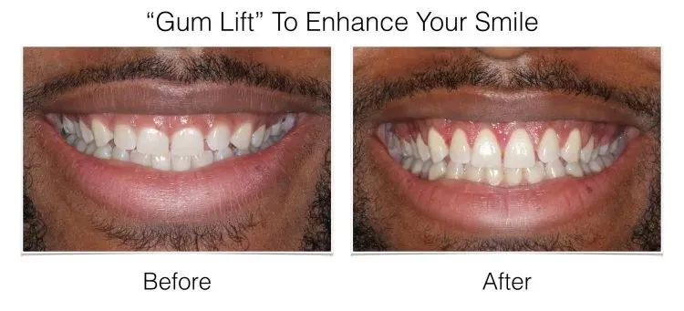 Gum lift before and after demonstrating enhanced smile with reduced gingival display