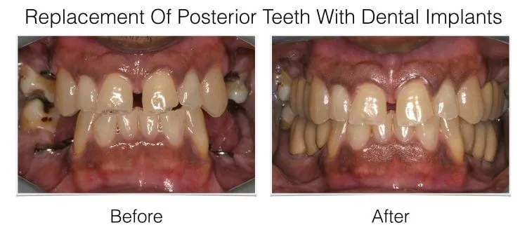 Web Layout Posterior Implants.001 e1642017907795 - Periodontist Philadelphia | Laudenbach Periodontics & Dental Implants