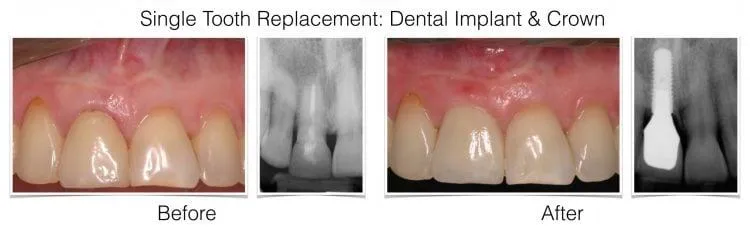 Web Layout Singe Implant.001 e1642017668413 - Periodontist Philadelphia | Laudenbach Periodontics & Dental Implants