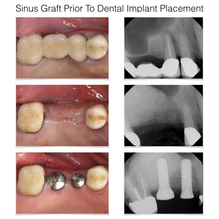 Sinus graft procedure stages with intraoral photos and X-rays showing implant site preparation