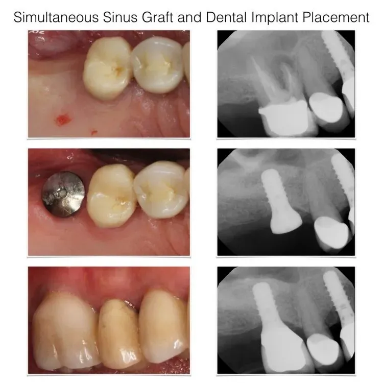 Simultaneous sinus graft and dental implant placement with intraoral and radiographic documentation