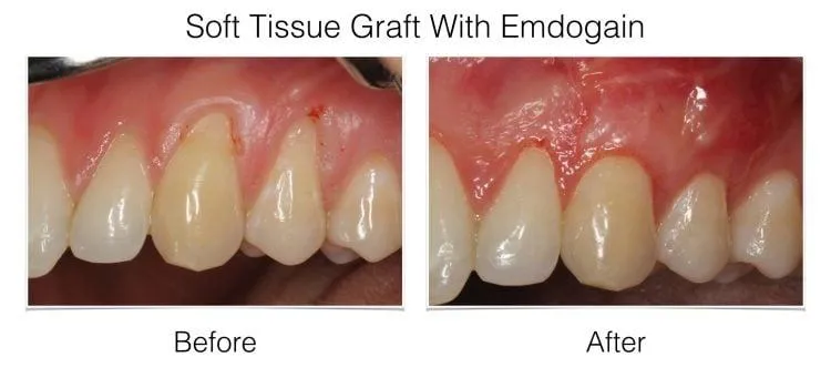 Laudenbach Periodontics soft tissue graft with Emdogain before and after displaying gum regeneration