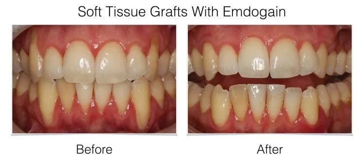 Laudenbach Periodontics soft tissue graft with Emdogain before and after results showing improved gum coverage