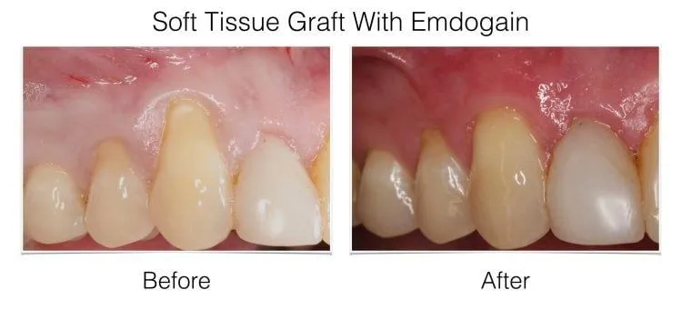 Before and after soft tissue graft with Endogain showing improved gum coverage around four front teeth