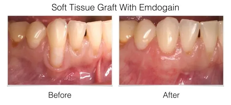 Web Layout Soft Tissue Graft.015 e1642017207389 - Periodontist Philadelphia | Laudenbach Periodontics & Dental Implants