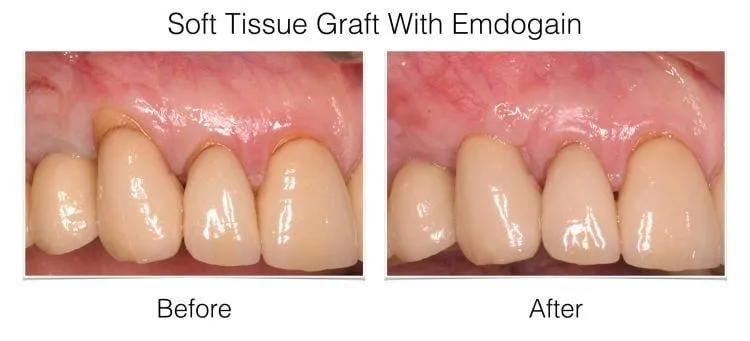 Before and after soft tissue graft with Endogain showing improved gum coverage on four front teeth
