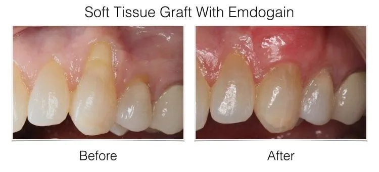 Web Layout Soft Tissue Graft.019 e1642016895618 - Periodontist Philadelphia | Laudenbach Periodontics & Dental Implants