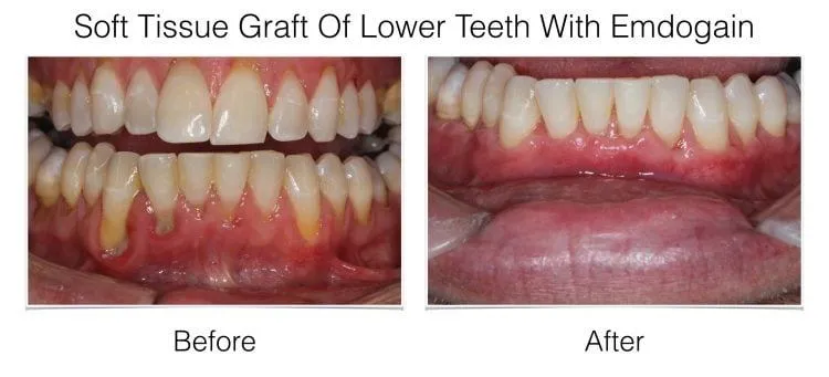 Web Layout Soft Tissue Graft.022 e1642016846261 - Periodontist Philadelphia | Laudenbach Periodontics & Dental Implants
