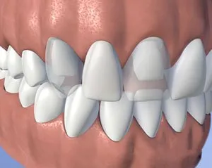 bridge - Periodontist Philadelphia | Laudenbach Periodontics & Dental Implants
