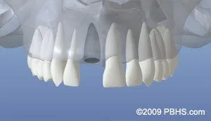 dentalimplant 02 - Periodontist Philadelphia | Laudenbach Periodontics & Dental Implants