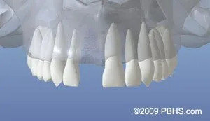 dentalimplant 03 - Periodontist Philadelphia | Laudenbach Periodontics & Dental Implants