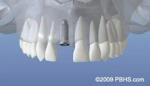 dentalimplant 05 - Periodontist Philadelphia | Laudenbach Periodontics & Dental Implants