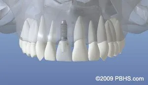 dentalimplant 06 - Periodontist Philadelphia | Laudenbach Periodontics & Dental Implants