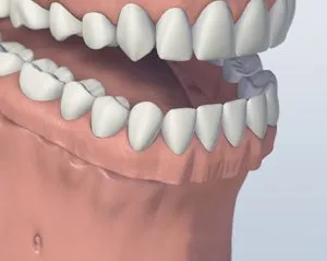 denture - Periodontist Philadelphia | Laudenbach Periodontics & Dental Implants
