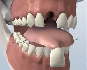 flipper - Periodontist Philadelphia | Laudenbach Periodontics & Dental Implants