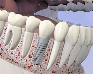 implant - Periodontist Philadelphia | Laudenbach Periodontics & Dental Implants