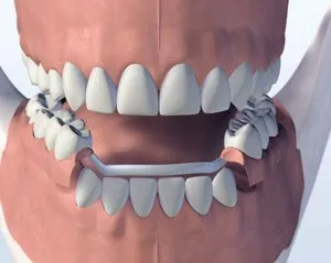 metalpartial - Periodontist Philadelphia | Laudenbach Periodontics & Dental Implants