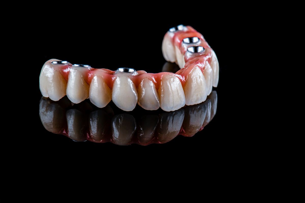 full arch ceramic bridge on implants