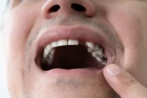 Man With Missing Tooth