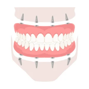 Removable denture on implants. Removable denture of the upper and lower jaw on four implants. Implant of the upper and lower jaw. Full arch prosthesis on dental implants. Vector illustration