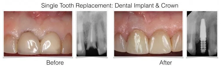 Before and after dental implant case showing tooth replacement with X-rays and intraoral photos