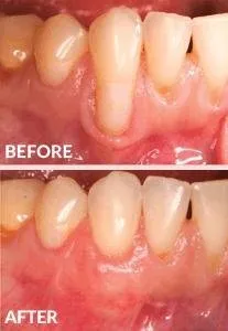 Before and after gum recession periodontal treatment on lower teeth