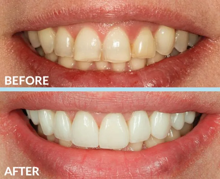 Before and after gummy smile correction treatment results