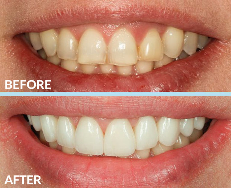 Gummy smile 2 - Periodontist Philadelphia | Laudenbach Periodontics & Dental Implants
