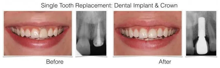 Single Implant Case 2 e1642017697323 - Periodontist Philadelphia | Laudenbach Periodontics & Dental Implants