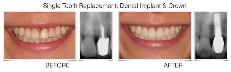 WEB TEMPLATE.001.png.001 e1642017683992 1 - Periodontist Philadelphia | Laudenbach Periodontics & Dental Implants