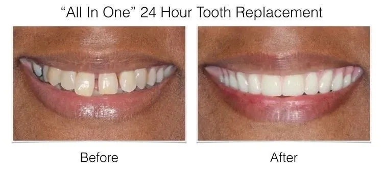 Before and after smile transformation photos from All In One 24 Hour Tooth Replacement procedure.