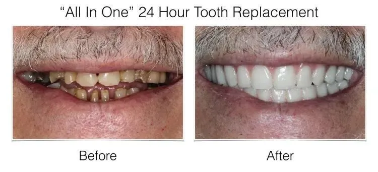 Before and after extraoral photos of All In One 24 Hour Tooth Replacement showing improved smile aesthetics.