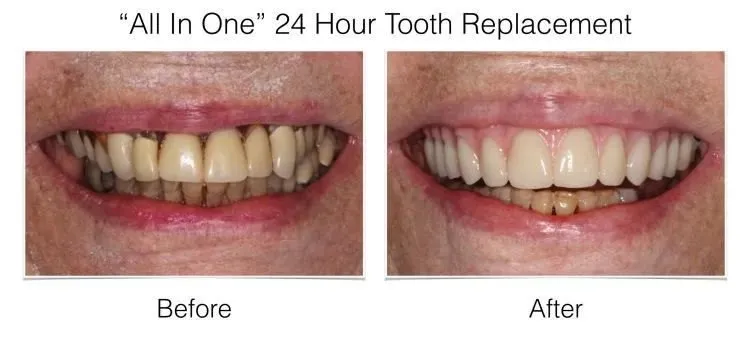 Before and after smile photos of All In One 24 Hour Tooth Replacement showing restoration of worn and discolored teeth.