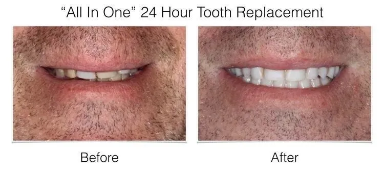 Before and after extraoral photos of All In One 24 Hour Tooth Replacement showing improved smile with natural white teeth.