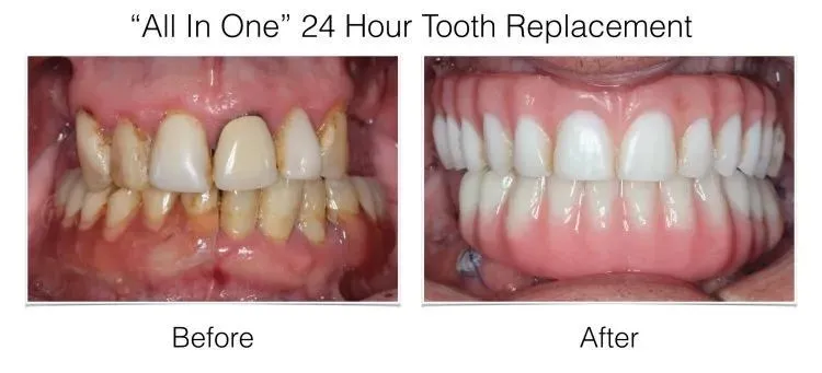Before and after intraoral photos of All In One 24 Hour Tooth Replacement showing discolored teeth transforming to bright whi
