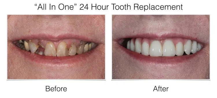 Before and after full mouth dental implant restoration showing improved teeth