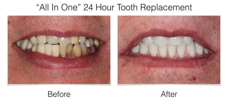 Before and after dental implant case with restored natural-looking smile