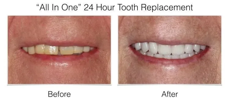 Before and after full mouth implant restoration case with improved smile aesthetics