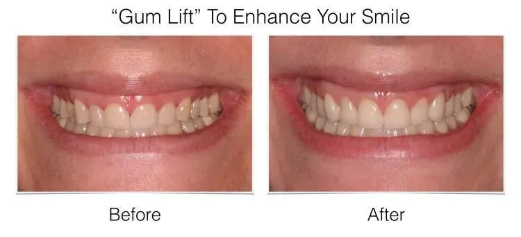 Gum grafting results at Laudenbach Periodontics Philadelphia