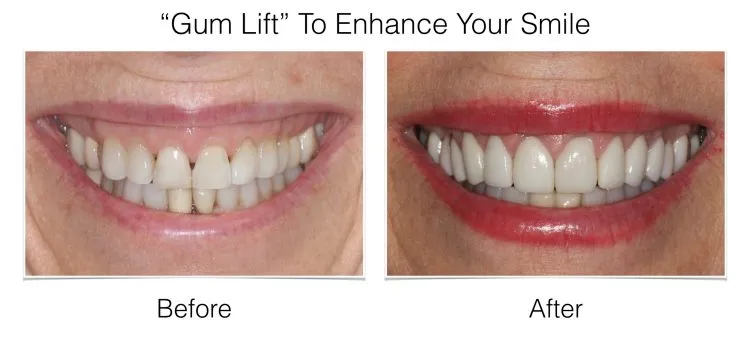 Web Layout Gum Lift.003 e1642018001358 - Periodontist Philadelphia | Laudenbach Periodontics & Dental Implants