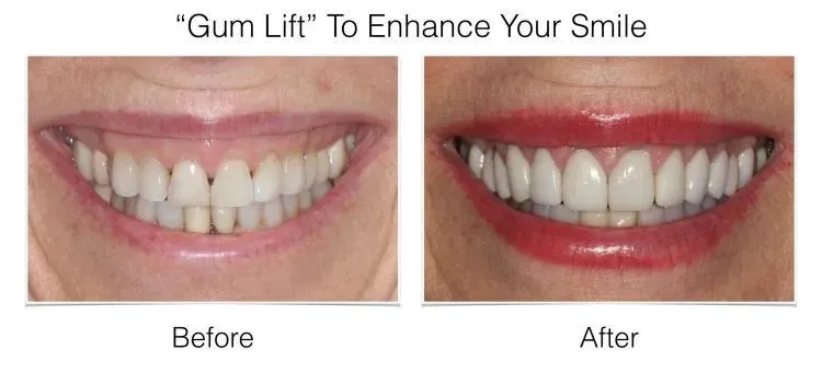 Gum lift before and after demonstrating enhanced smile aesthetics