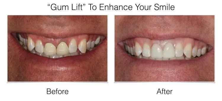 Gum lift before and after showing improved smile with reduced gum display