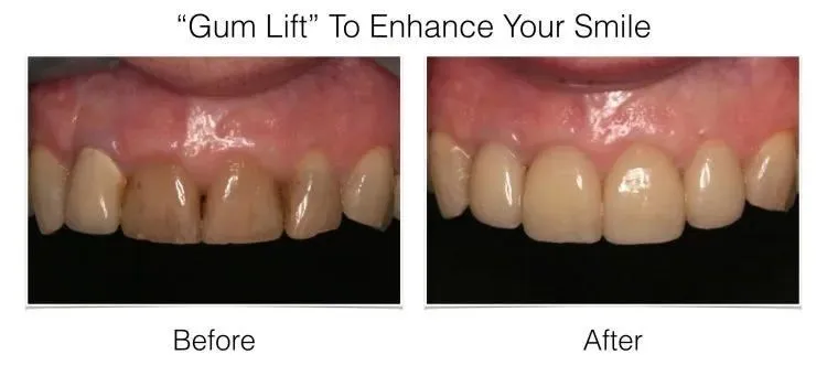 Before and after photos of gum lift smile enhancement at Laudenbach Periodontics