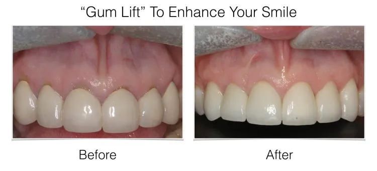 Web Layout Gum Lift.008 e1642018015784 - Periodontist Philadelphia | Laudenbach Periodontics & Dental Implants