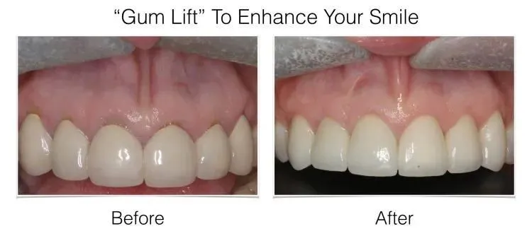 Before and after photos of gum lift procedure at Laudenbach Periodontics