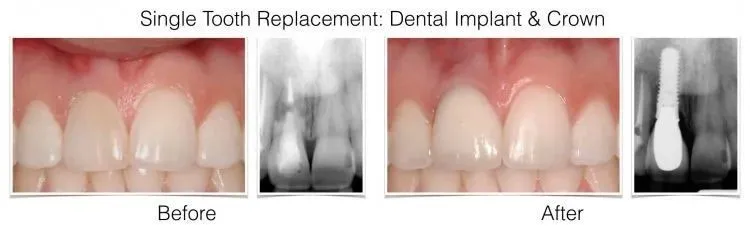 Web Layout Singe Implant.002 e1642017644233 1 - Periodontist Philadelphia | Laudenbach Periodontics & Dental Implants