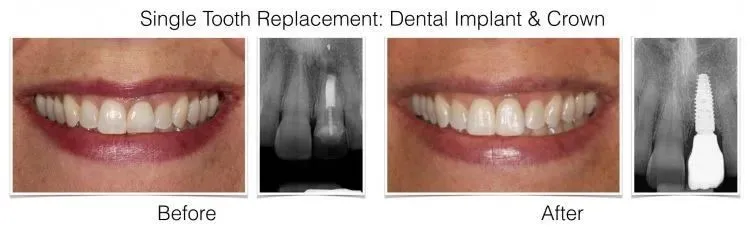 Web Layout Singe Implant.005.jpeg.001 e1642017622679 - Periodontist Philadelphia | Laudenbach Periodontics & Dental Implants