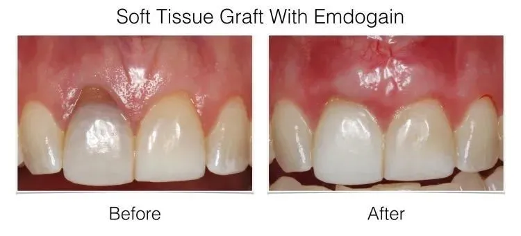 Soft tissue graft with Emdogain before and after: anterior teeth showing gum recession treatment outcome